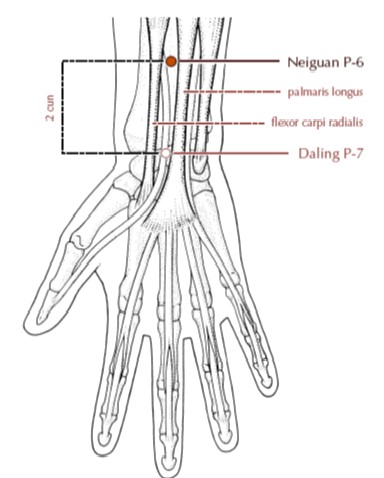 Nei Guan (Pc-6) punto muy utlizado para patologías internas, otro comodín. Punto que se sumó a Gao Wu.