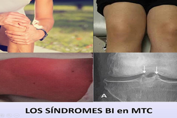 Los Síndromes Bi en MTC