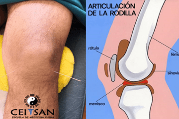 Tratamiento de la Rodilla con MTC